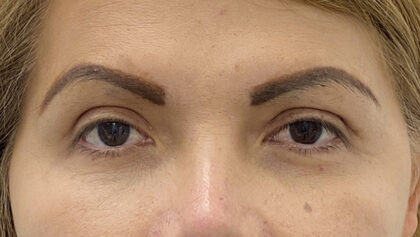 Eye Lift Before & After Patient #1893