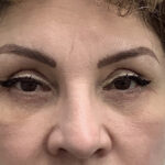 Eye Lift Before & After Patient #1897