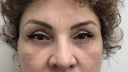 Eye Lift Before & After Patient #1897