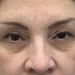 Eye Lift Before & After Patient #1897