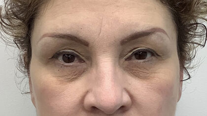 Eye Lift Before & After Patient #1897