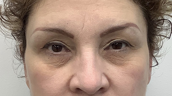 Eye Lift Before & After Patient #1897