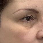 Eye Lift Before & After Patient #1897