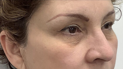 Eye Lift Before & After Patient #1897