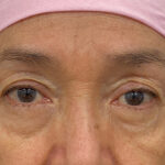 Eye Lift Before & After Patient #1857