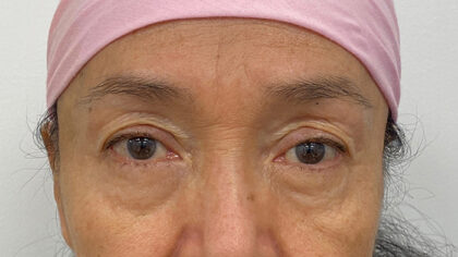 Eye Lift Before & After Patient #1857