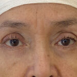 Eye Lift Before & After Patient #1857