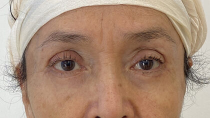 Eye Lift Before & After Patient #1857