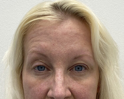 Eye Lift Before & After Patient #1860