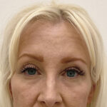 Eye Lift Before & After Patient #1860