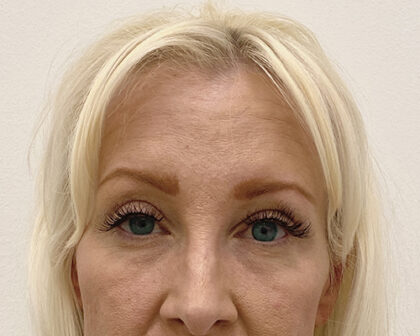 Eye Lift Before & After Patient #1860