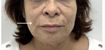 Facial Fillers Before & After Patient #1909