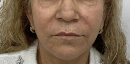 Facial Fillers Before & After Patient #1917