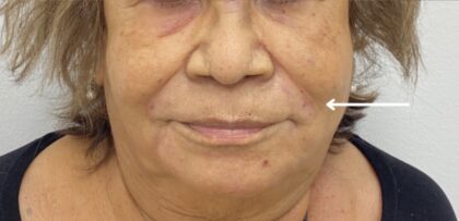 Facial Fillers Before & After Patient #1912