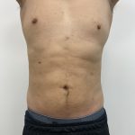 Liposculpture Before & After Patient #1984