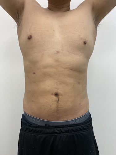 Liposculpture Before & After Patient #1984