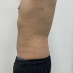 Liposculpture Before & After Patient #1984