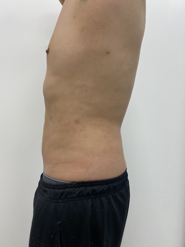 Liposculpture Before & After Patient #1984