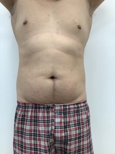 Liposculpture Before & After Patient #1984