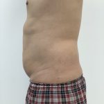 Liposculpture Before & After Patient #1984