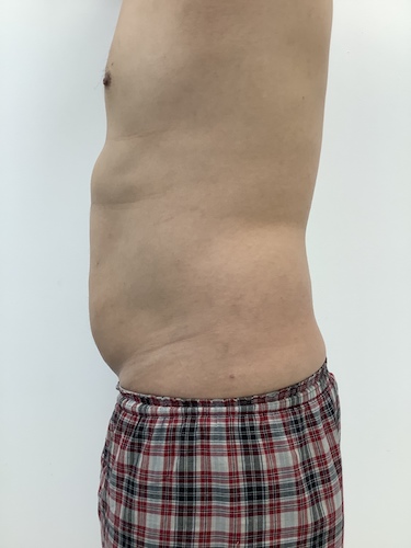 Liposculpture Before & After Patient #1984