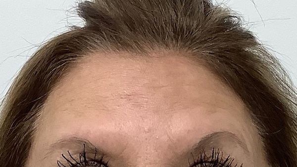Botox Before & After Patient #1978