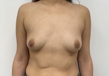 Breast Augmentation Before & After Patient #1937