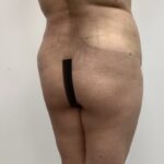 Brazilian Butt Lift Before & After Patient #1928