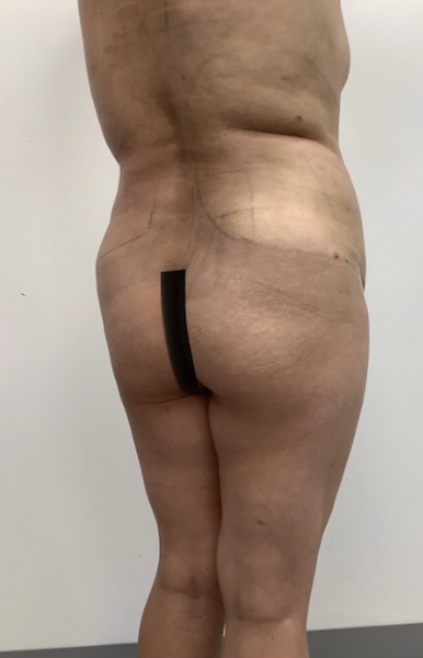 Brazilian Butt Lift Before & After Patient #1928