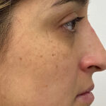 Non-Surgical Rhinoplasty Before & After Patient #1931