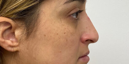 Non-Surgical Rhinoplasty Before & After Patient #1931