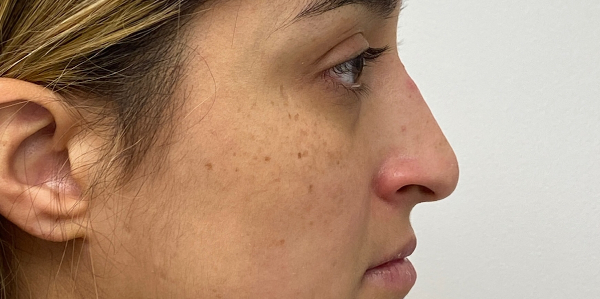Non-Surgical Rhinoplasty Before & After Patient #1931