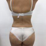 Brazilian Butt Lift Before & After Patient #1925