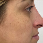 Non-Surgical Rhinoplasty Before & After Patient #1931