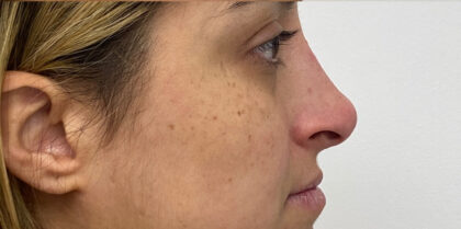 Non-Surgical Rhinoplasty Before & After Patient #1931
