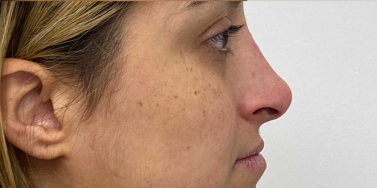 Non-Surgical Rhinoplasty Before & After Patient #1931