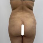 Brazilian Butt Lift Before & After Patient #1925