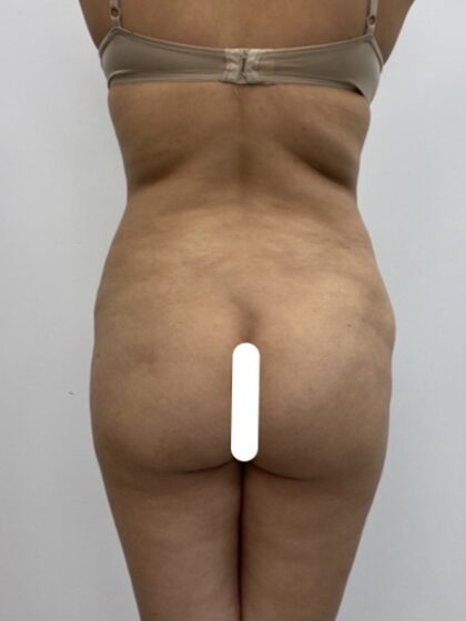 Brazilian Butt Lift Before & After Patient #1925