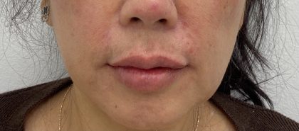 Lip Fillers Before & After Patient #2000