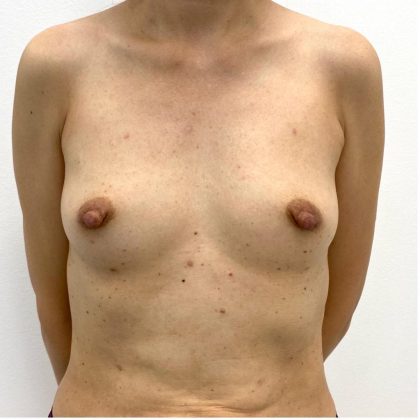 Breast Augmentation Before & After Patient #1989