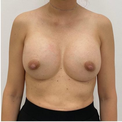 Breast Augmentation Before & After Patient #1989