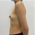 Breast Augmentation Before & After Patient #1989