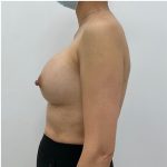 Breast Augmentation Before & After Patient #1989