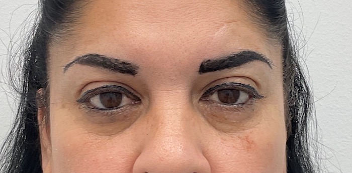 Under Eye Fillers Before & After Patient #2035