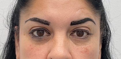 Facial Fillers Before & After Patient #2035