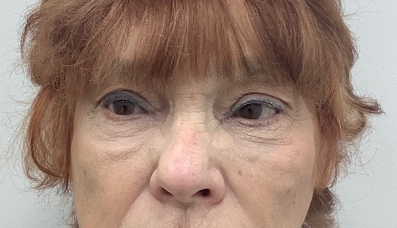 Under Eye Fillers Before & After Patient #2038