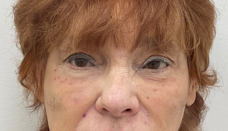 Under Eye Fillers Before & After Patient #2038