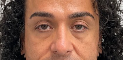 Under Eye Fillers Before & After Patient #2083