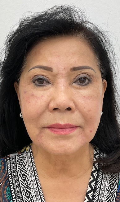 Facial Fillers Before & After Patient #2032