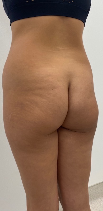 Fat Transfer Before & After Patient #2077